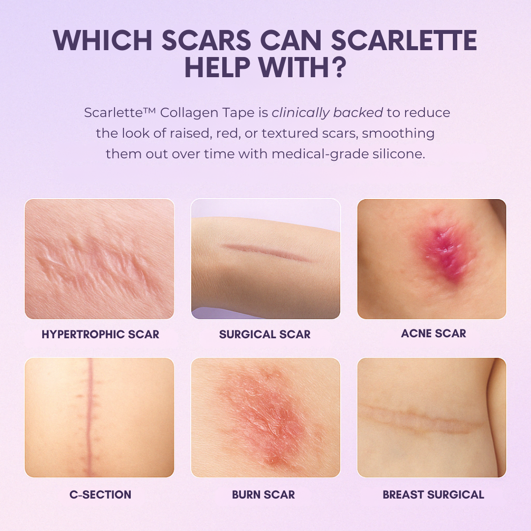 Scarlette™ Silicone Collagen Sheet