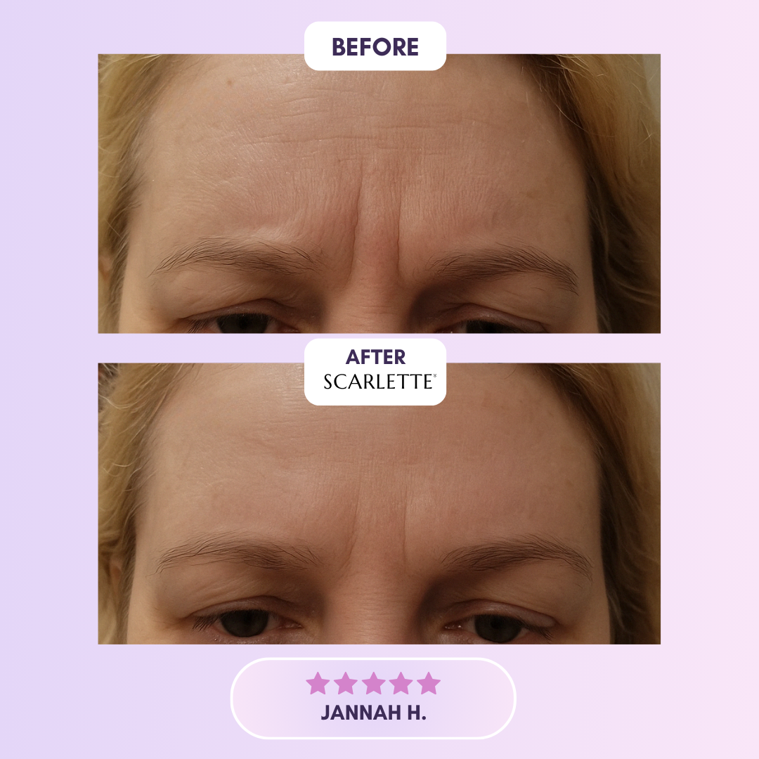 Scarlette™ Silicone Scar Sheet